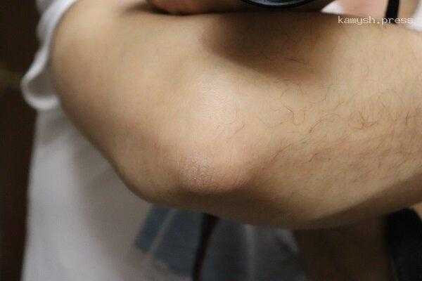 Дерматовенеролог Нагибина рассказала о методах избавления мозолей на локтях