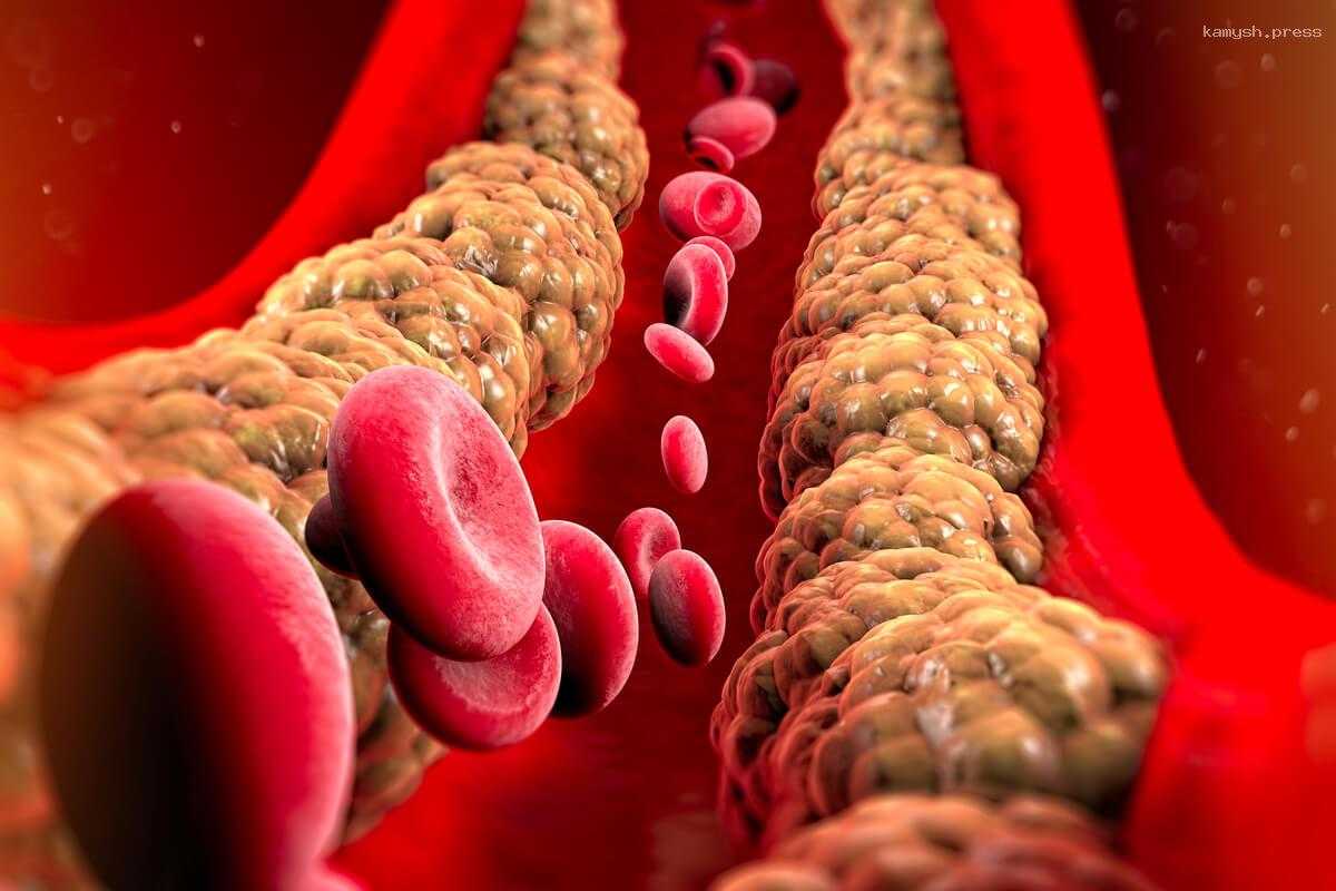 Перечислены факторы, влияющие на повышение уровня холестерина