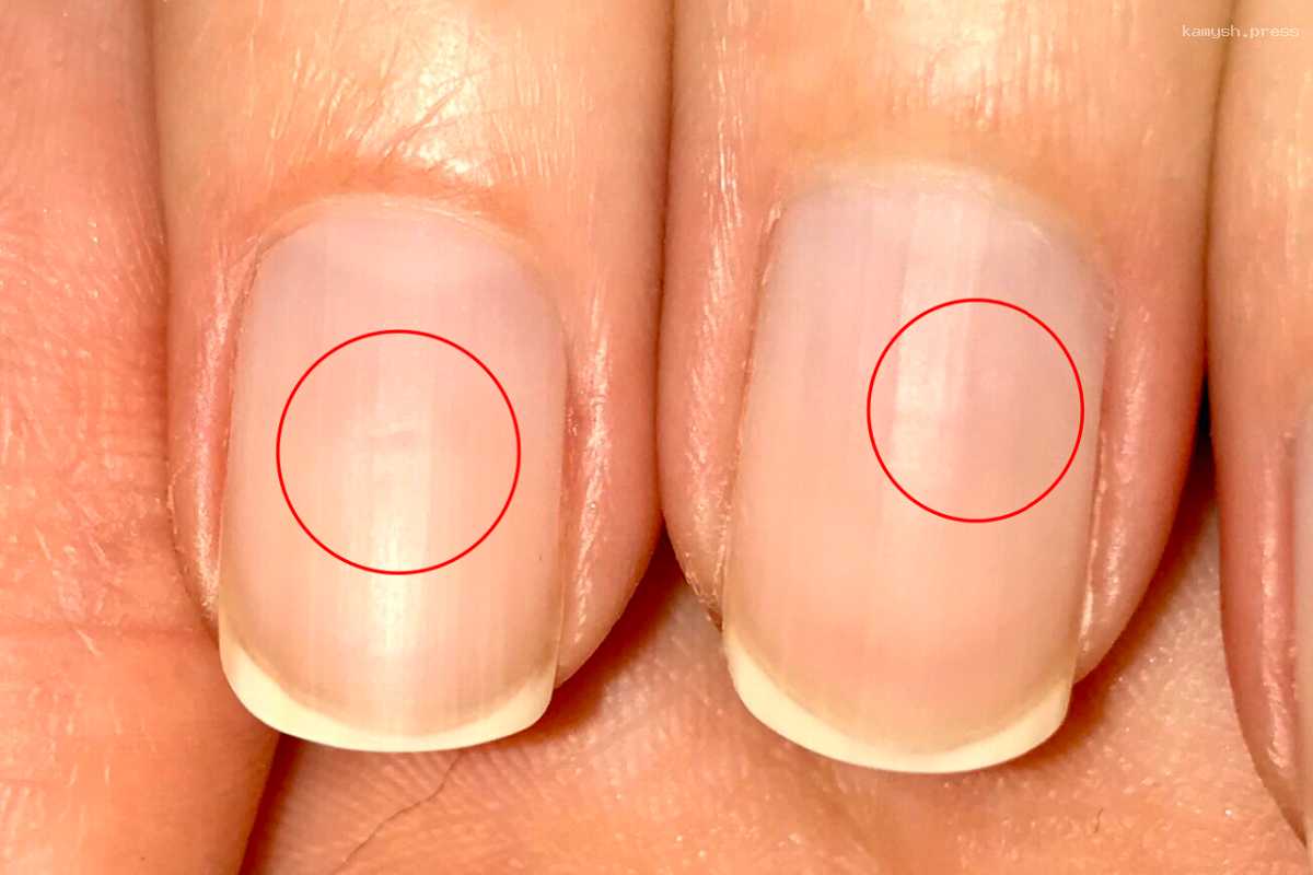 Ученые предупредили об опасности развития рака людей с онихопапилломой