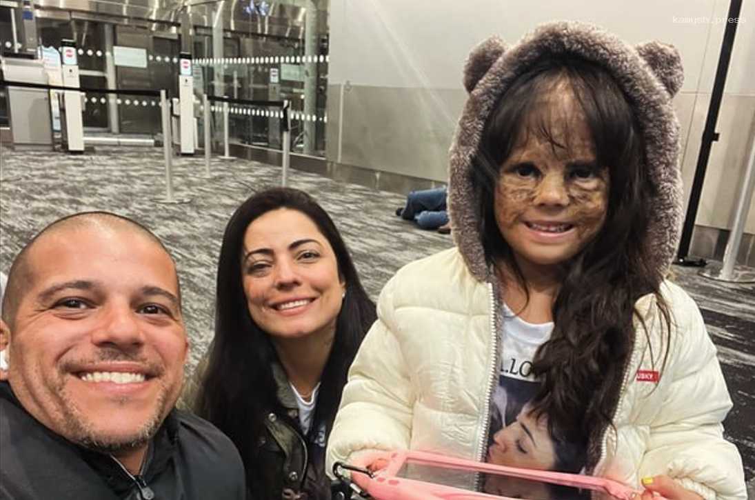 Онколог Попов рассказал, чем уникален случай девочки из США с «лицом Бэтмена»