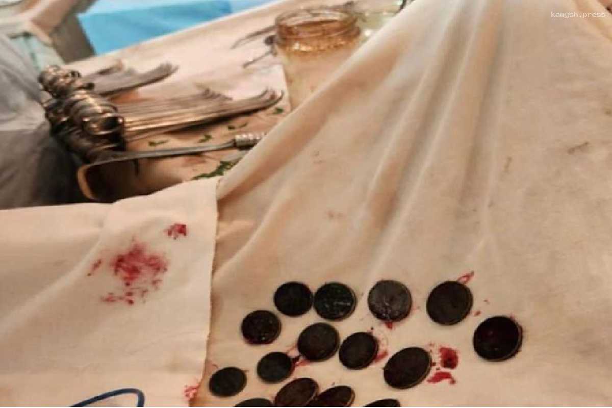 Хирург из РостГМУ вынула из желудка жителя Херсонской области 26 монет