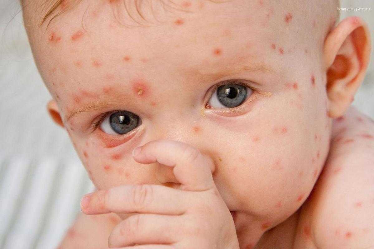 В Липецкой областной больнице предотвратили вспышку кори