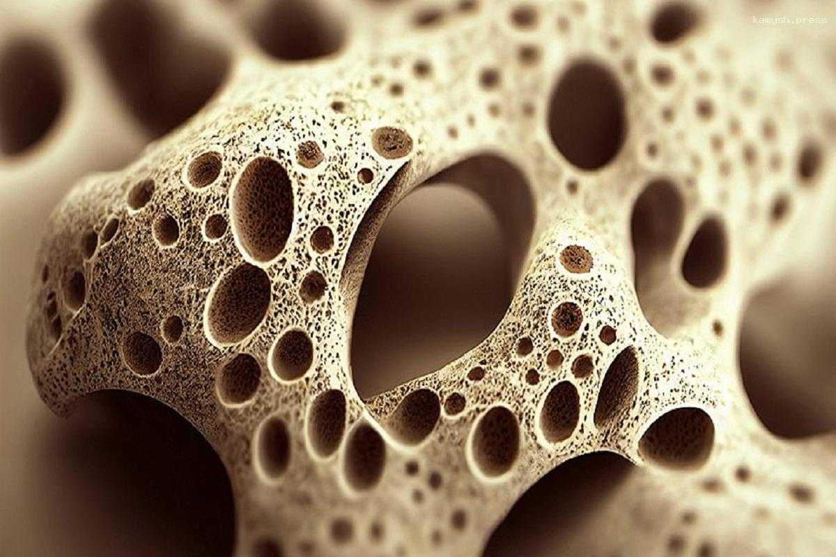Врач Мясников заявил о невозможности выявить остеопороз на ранней стадии