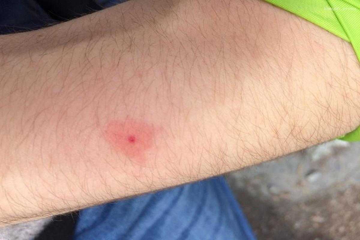 В Ленинградской области начался сезон активности клещей