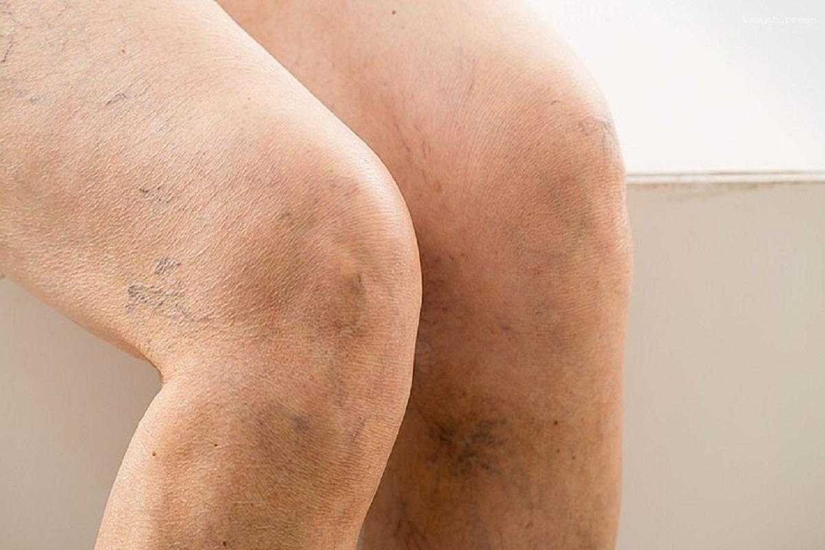 Флеболог Копылов рассказал о методах профилактики варикоза