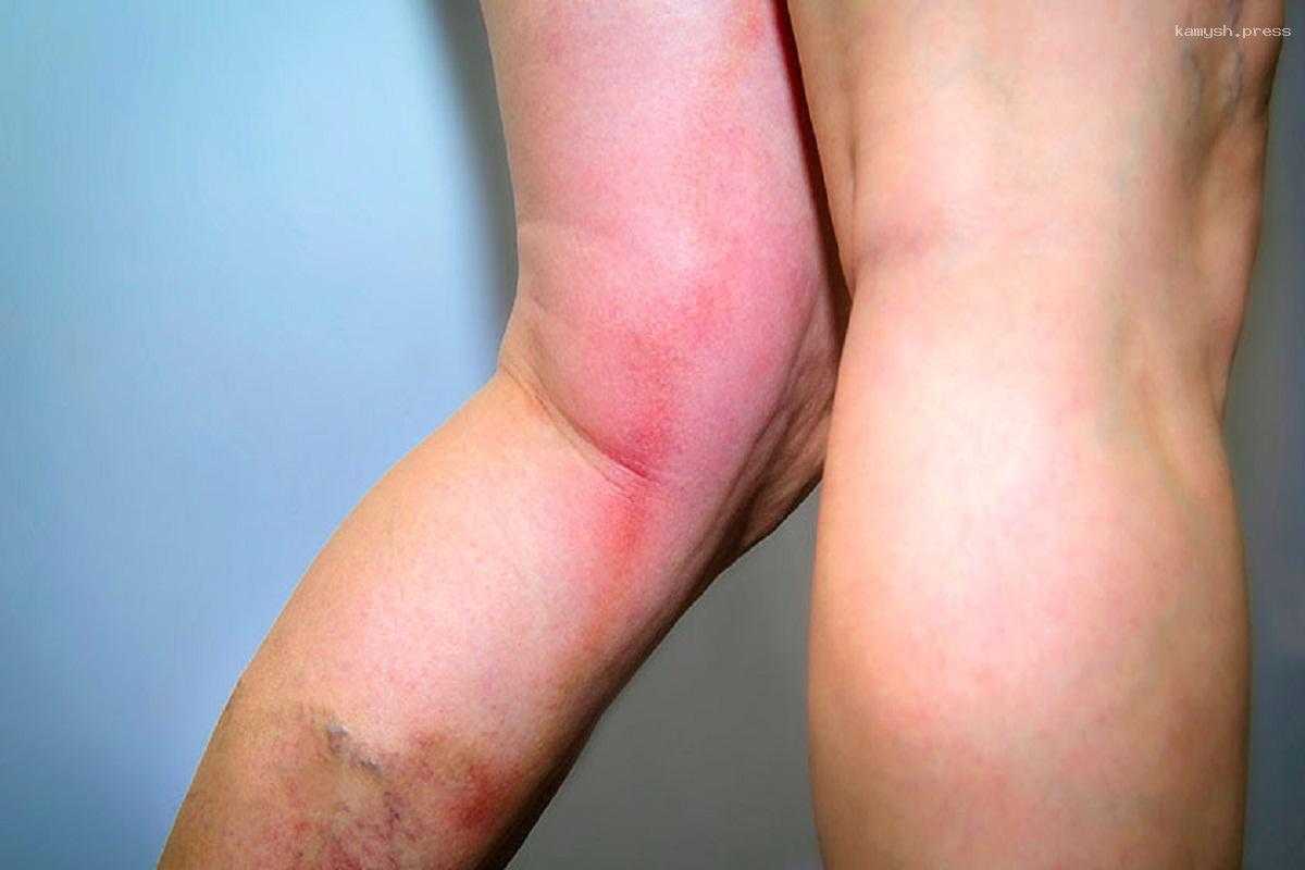 Ростовские врачи диагностировали у пациентки с жалобами на усталость смертельную болезнь