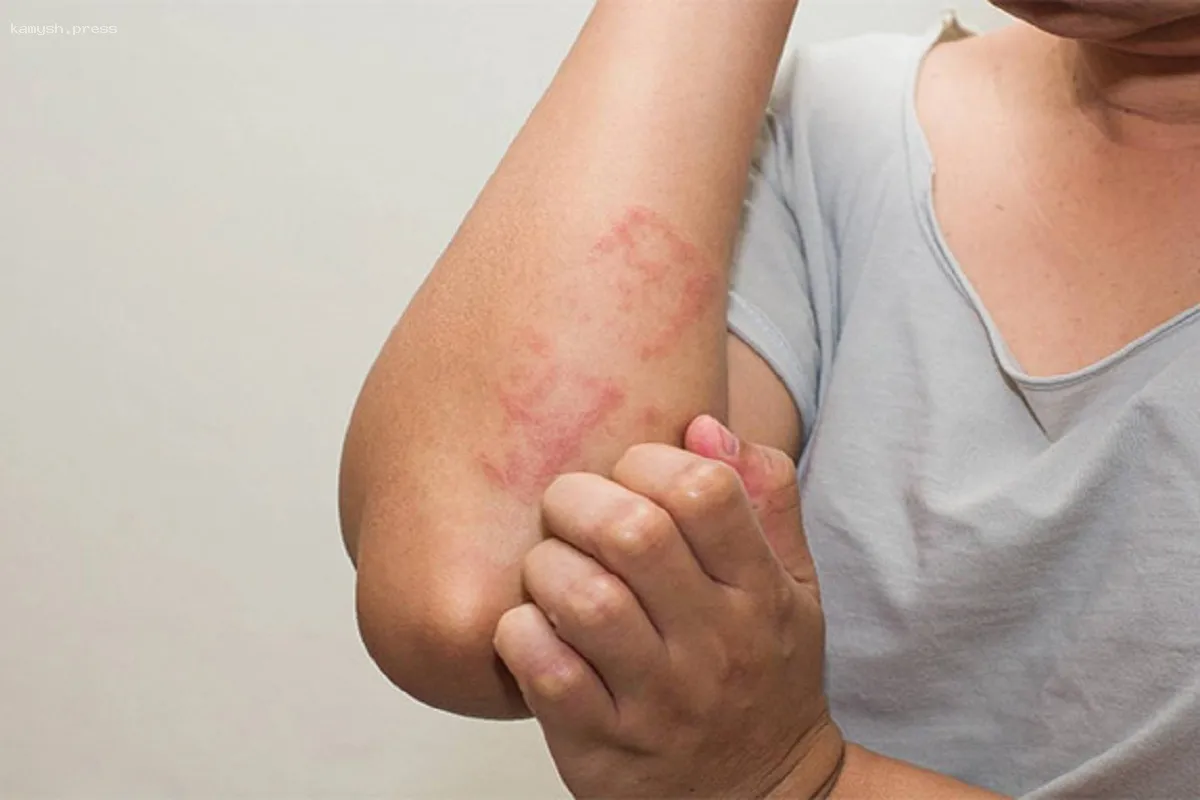 Врачи рассказали о неочевидных признаках наличия гельминтов в организме, сказывающихся на состоянии кожи