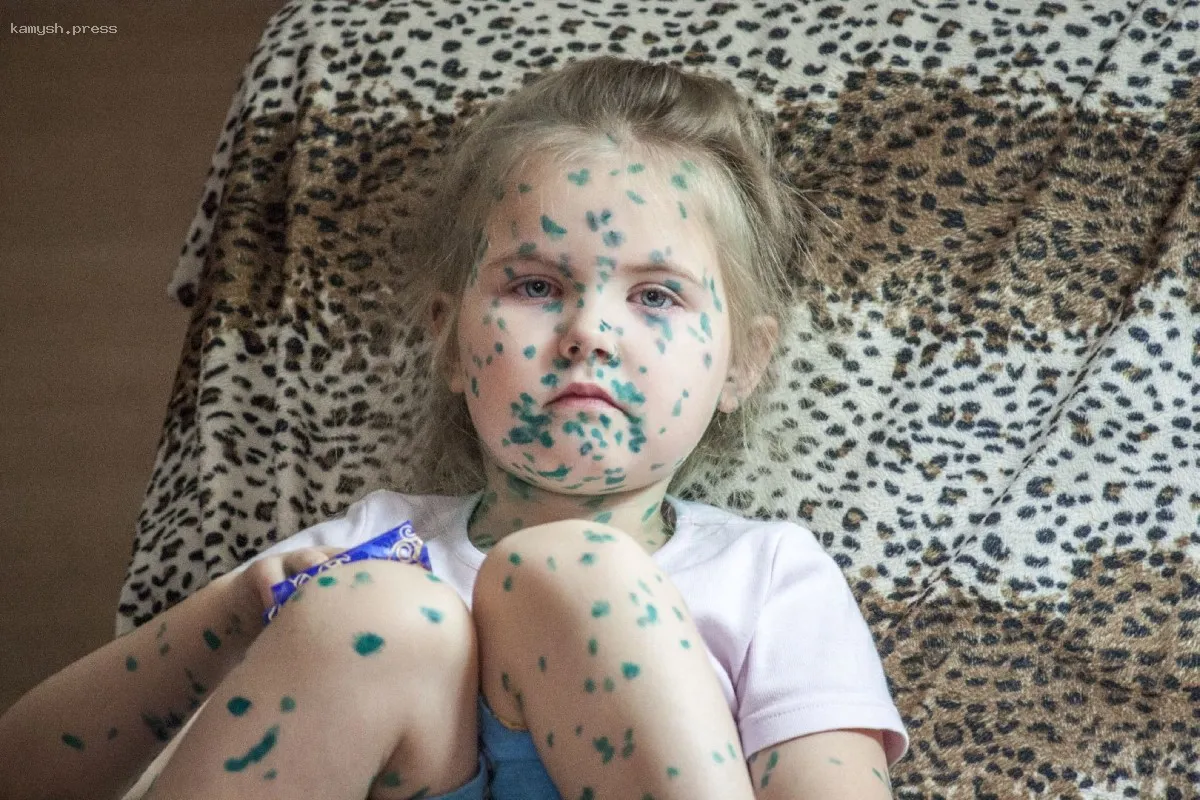 Опасности намеренного заражения ветрянкой стали известны