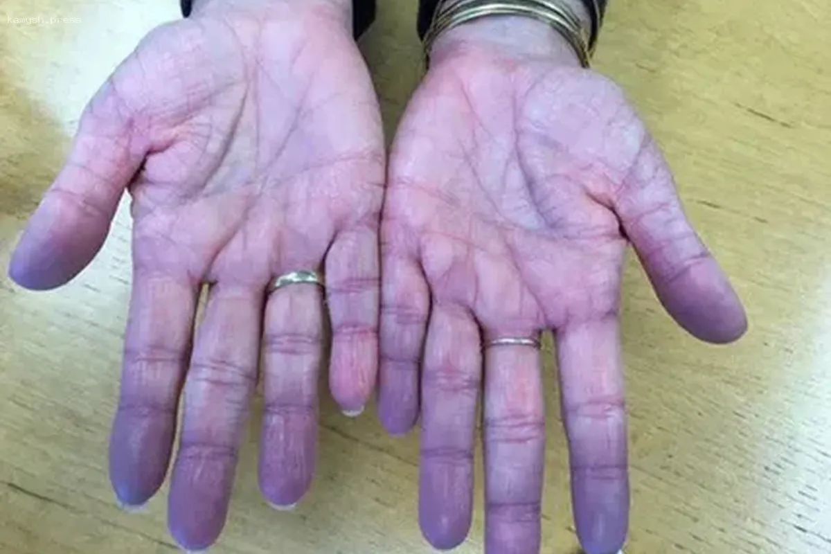 Доктор озвучил опасные признаки тромбообразования