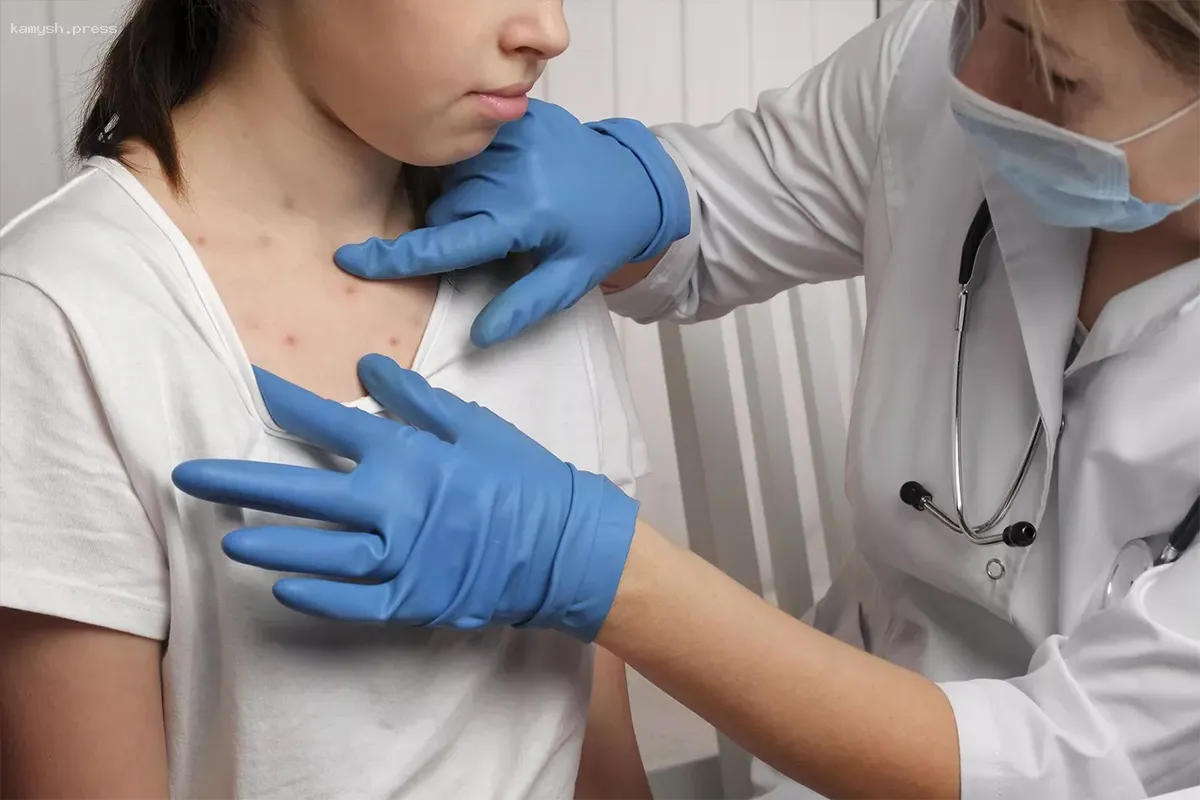 Заболевание корью зарегистрировано в 27 штатах США