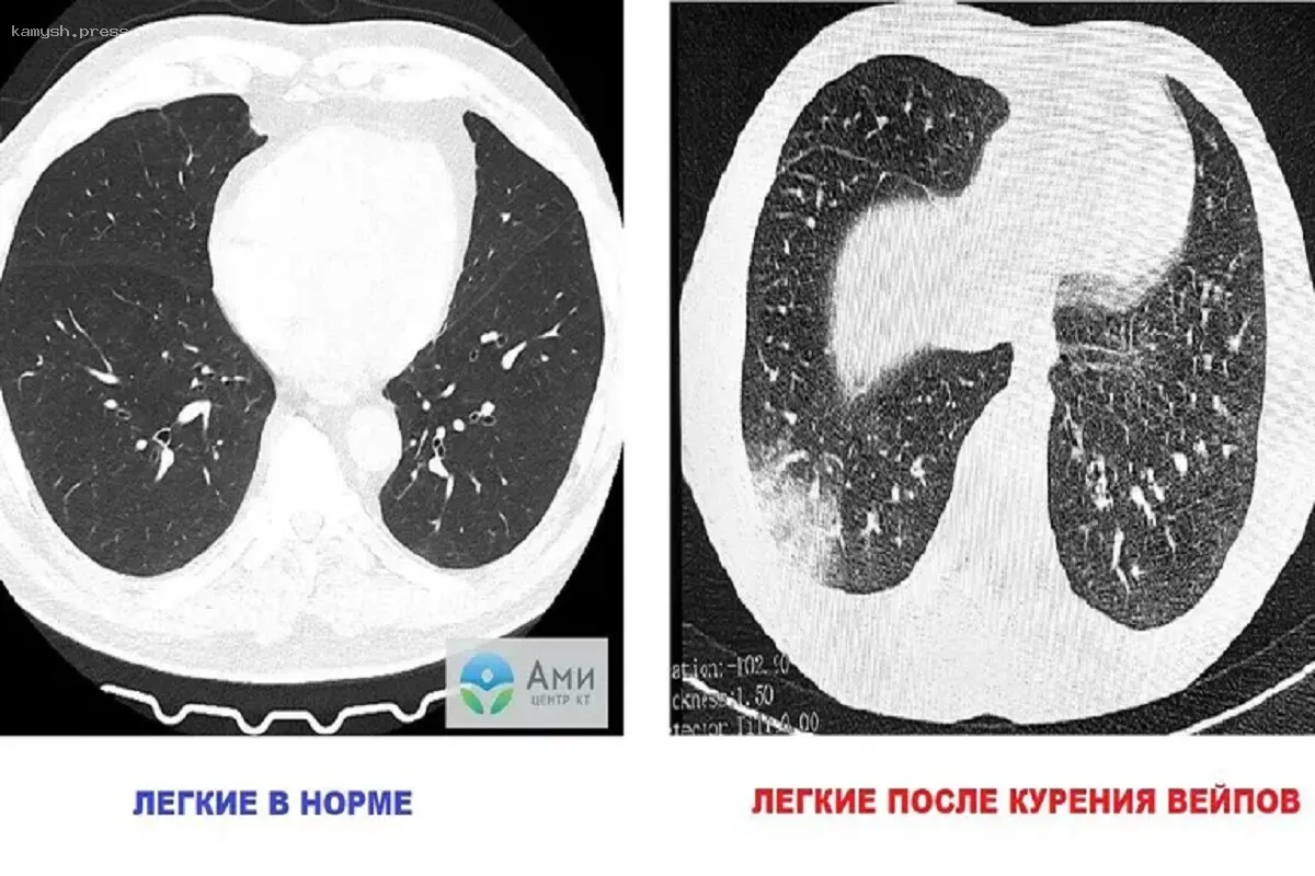 Доктор Нефедов предостерег о рисках использования вейпов